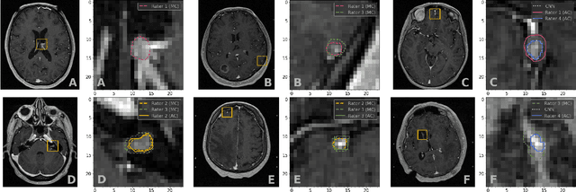 Figure 3 for Systematic Clinical Evaluation of A Deep Learning Method for Medical Image Segmentation: Radiosurgery Application