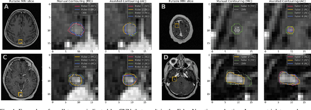 Figure 4 for Systematic Clinical Evaluation of A Deep Learning Method for Medical Image Segmentation: Radiosurgery Application