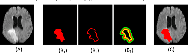 Figure 3 for Offset Curves Loss for Imbalanced Problem in Medical Segmentation