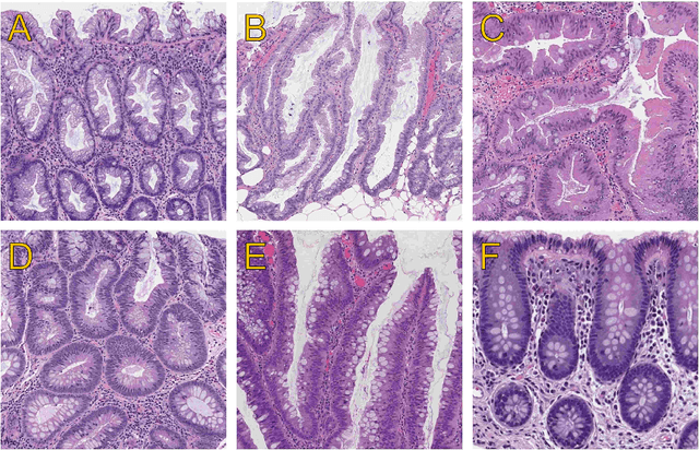 Figure 1 for Deep-Learning for Classification of Colorectal Polyps on Whole-Slide Images