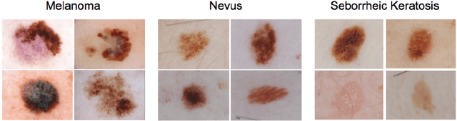 Figure 1 for Skin Lesion Classification Using Deep Multi-scale Convolutional Neural Networks