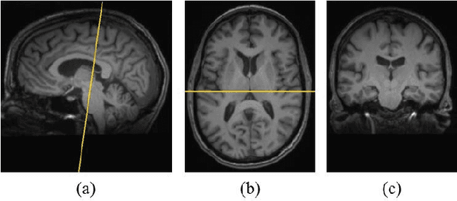 Figure 3 for Texture Classification of MR Images of the Brain in ALS using CoHOG