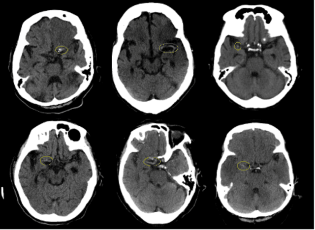 Figure 1 for Automated Segmentation for Hyperdense Middle Cerebral Artery Sign of Acute Ischemic Stroke on Non-Contrast CT Images