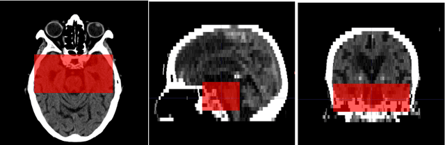 Figure 3 for Automated Segmentation for Hyperdense Middle Cerebral Artery Sign of Acute Ischemic Stroke on Non-Contrast CT Images