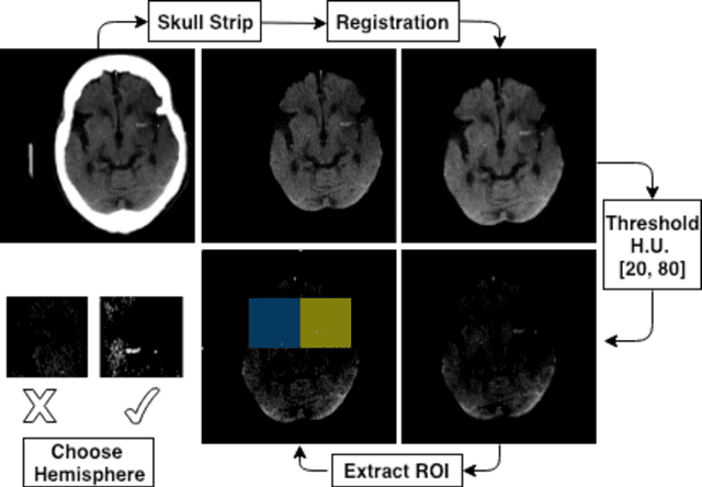 Figure 4 for Automated Segmentation for Hyperdense Middle Cerebral Artery Sign of Acute Ischemic Stroke on Non-Contrast CT Images