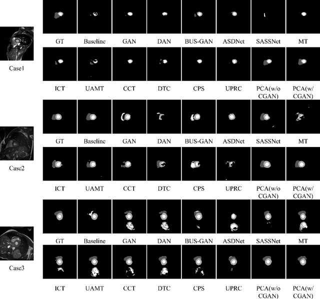 Figure 4 for PCA: Semi-supervised Segmentation with Patch Confidence Adversarial Training