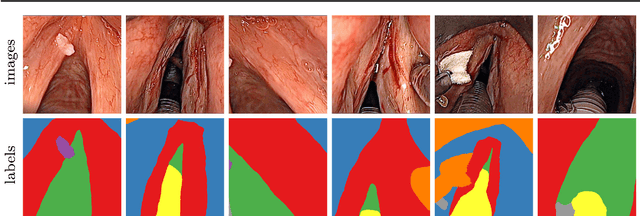 Figure 1 for A Dataset of Laryngeal Endoscopic Images with Comparative Study on Convolution Neural Network Based Semantic Segmentation