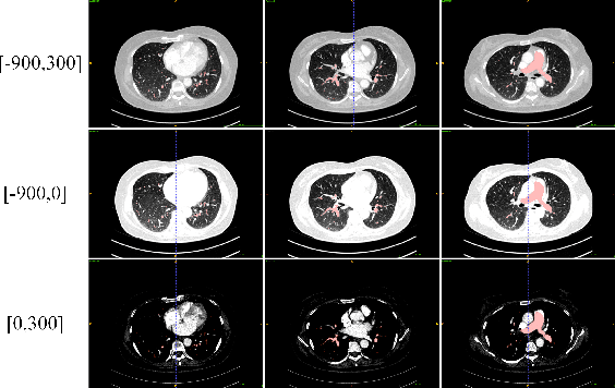 Figure 1 for A multi view multi stage and multi window framework for pulmonary artery segmentation from CT scans