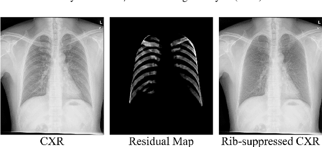 Figure 1 for GAN-based disentanglement learning for chest X-ray rib suppression