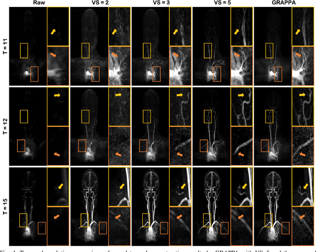 Figure 4 for Unsupervised Deep Learning for MR Angiography with Flexible Temporal Resolution