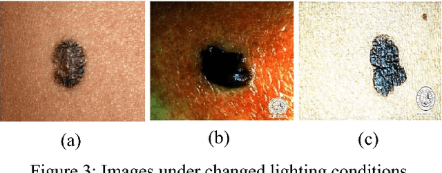 Figure 3 for Automatic Lesion Detection System (ALDS) for Skin Cancer Classification Using SVM and Neural Classifiers