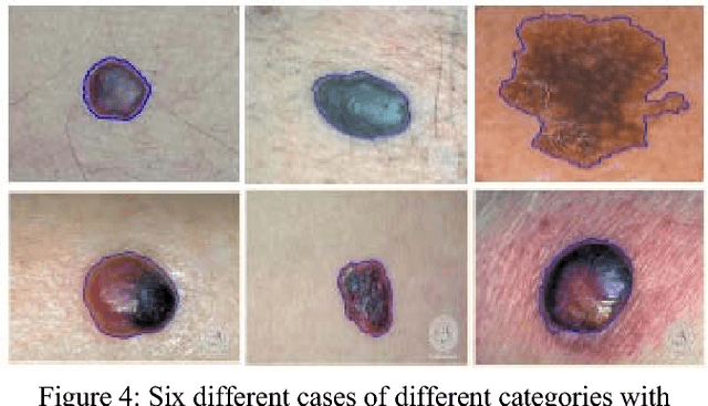Figure 4 for Automatic Lesion Detection System (ALDS) for Skin Cancer Classification Using SVM and Neural Classifiers
