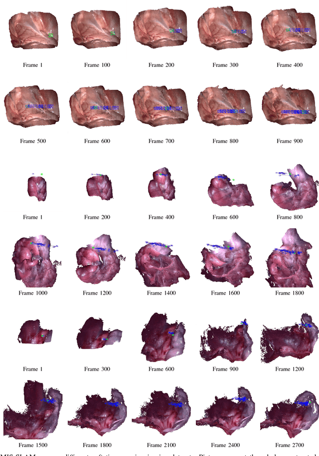 Figure 3 for MIS-SLAM: Real-time Large Scale Dense Deformable SLAM System in Minimal Invasive Surgery Based on Heterogeneous Computing