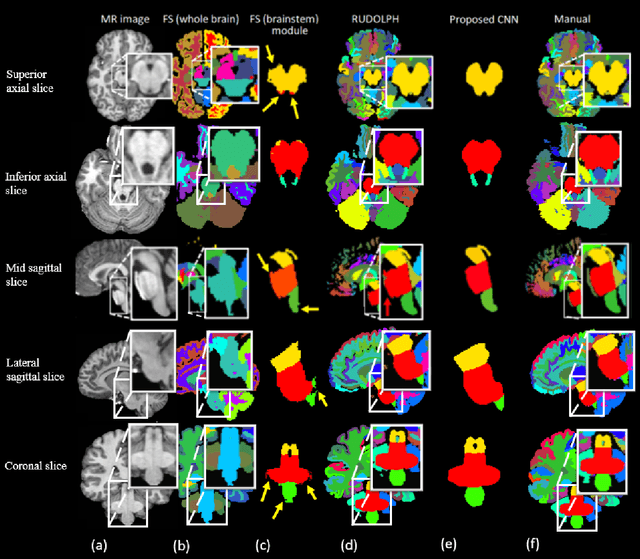 Figure 4 for Automated brainstem parcellation using multi-atlas segmentation and deep neural network