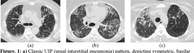 Figure 2 for Quantitative CT texture-based method to predict diagnosis and prognosis of fibrosing interstitial lung disease patterns