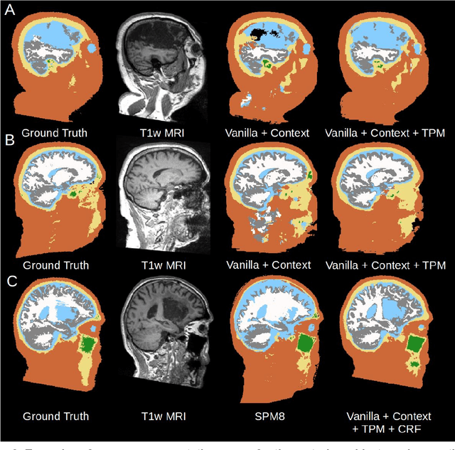 Figure 3 for Tissue segmentation with deep 3D networks and spatial priors