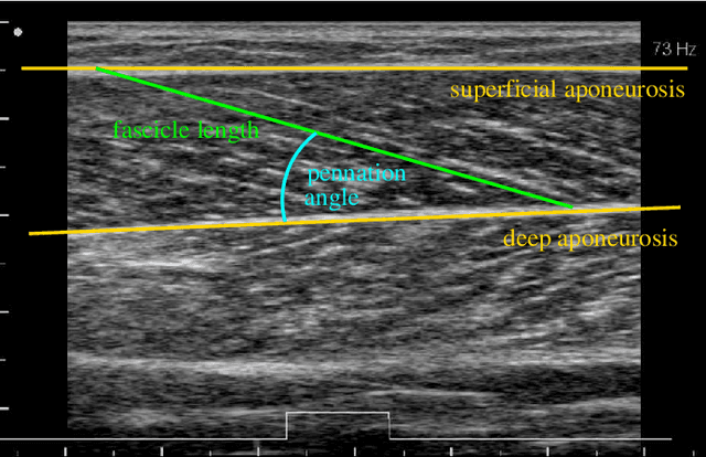 Figure 1 for Estimation of Muscle Fascicle Orientation in Ultrasonic Images