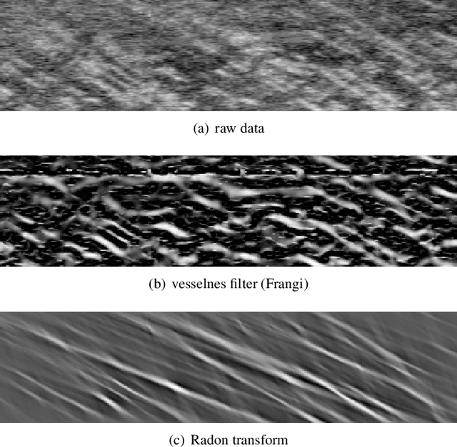 Figure 3 for Estimation of Muscle Fascicle Orientation in Ultrasonic Images