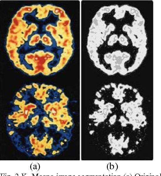 Figure 2 for Segmentation of Alzheimers Disease in PET scan datasets using MATLAB