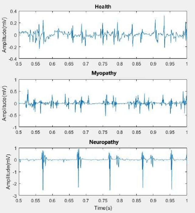 Figure 1 for A complex network approach to time series analysis with application in diagnosis of neuromuscular disorders