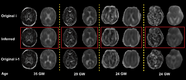 Figure 4 for Slice estimation in diffusion MRI of neonatal and fetal brains in image and spherical harmonics domains using autoencoders