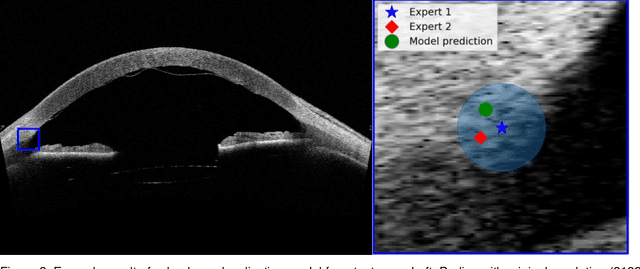 Figure 4 for Quantifying Graft Detachment after Descemet's Membrane Endothelial Keratoplasty with Deep Convolutional Neural Networks