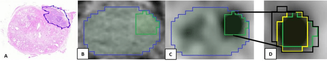 Figure 4 for Convolutional neural network based deep-learning architecture for intraprostatic tumour contouring on PSMA PET images in patients with primary prostate cancer