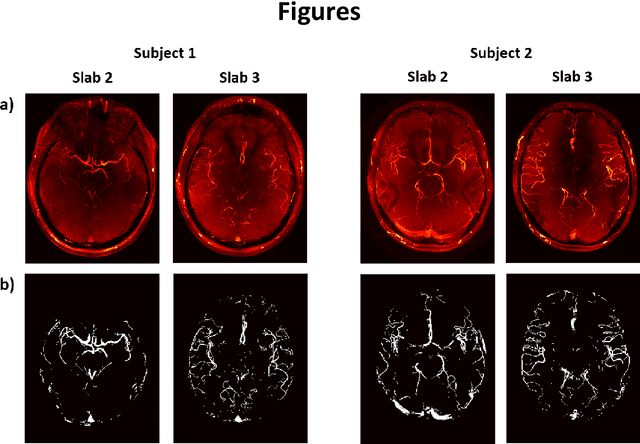 Figure 1 for Optimization of Undersampling Parameters for 3D Intracranial Compressed Sensing MR Angiography at 7 Tesla
