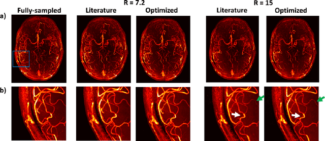 Figure 3 for Optimization of Undersampling Parameters for 3D Intracranial Compressed Sensing MR Angiography at 7 Tesla