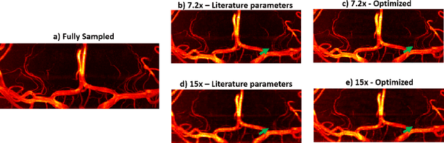 Figure 4 for Optimization of Undersampling Parameters for 3D Intracranial Compressed Sensing MR Angiography at 7 Tesla