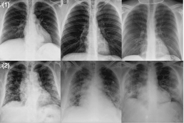 Figure 3 for COVID-Net CXR-S: Deep Convolutional Neural Network for Severity Assessment of COVID-19 Cases from Chest X-ray Images