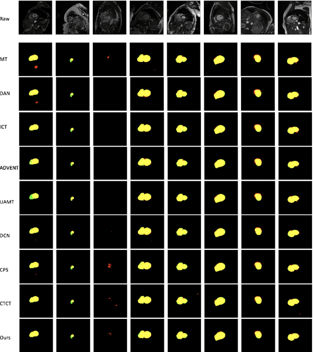 Figure 4 for When CNN Meet with ViT: Towards Semi-Supervised Learning for Multi-Class Medical Image Semantic Segmentation