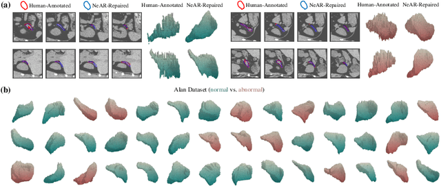 Figure 1 for Neural Annotation Refinement: Development of a New 3D Dataset for Adrenal Gland Analysis