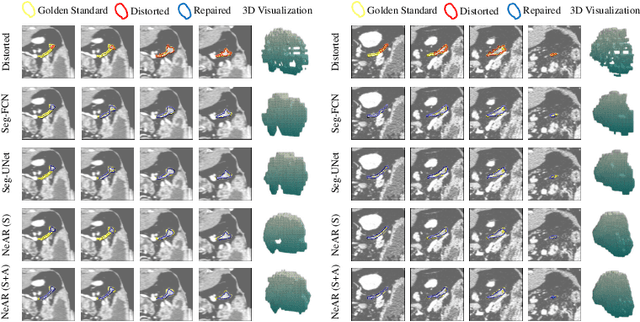 Figure 4 for Neural Annotation Refinement: Development of a New 3D Dataset for Adrenal Gland Analysis