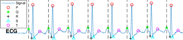 Figure 2 for An Unsupervised Feature Learning Approach to Reduce False Alarm Rate in ICUs