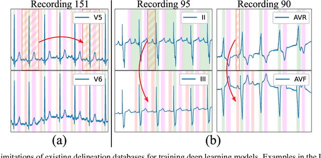 Figure 1 for Generalizing electrocardiogram delineation: training convolutional neural networks with synthetic data augmentation