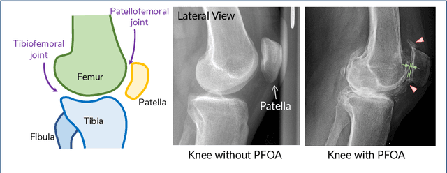 Figure 1 for Machine Learning Based Texture Analysis of Patella from X-Rays for Detecting Patellofemoral Osteoarthritis