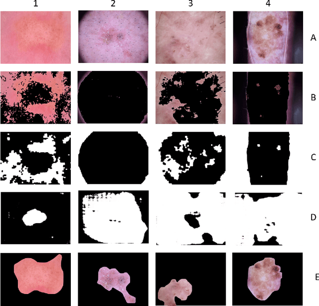 Figure 4 for Improving Lesion Detection by exploring bias on Skin Lesion dataset