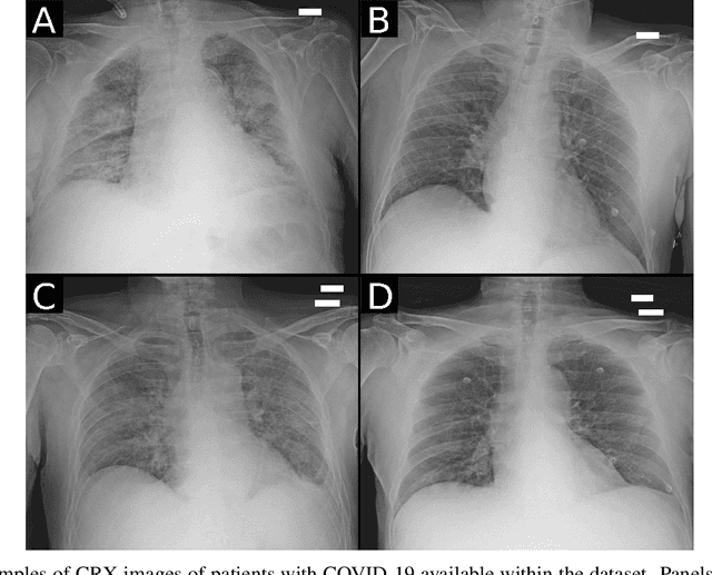 Figure 4 for AIforCOVID: predicting the clinical outcomes in patients with COVID-19 applying AI to chest-X-rays. An Italian multicentre study