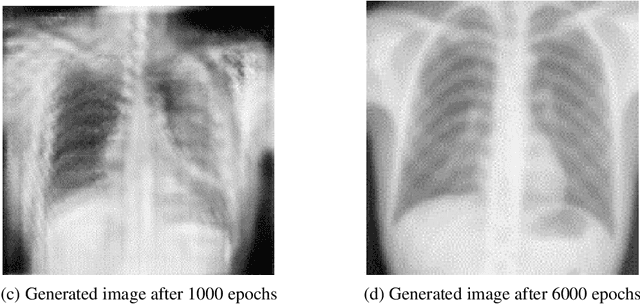 Figure 3 for Deep Learning Methods for Screening Pulmonary Tuberculosis Using Chest X-rays