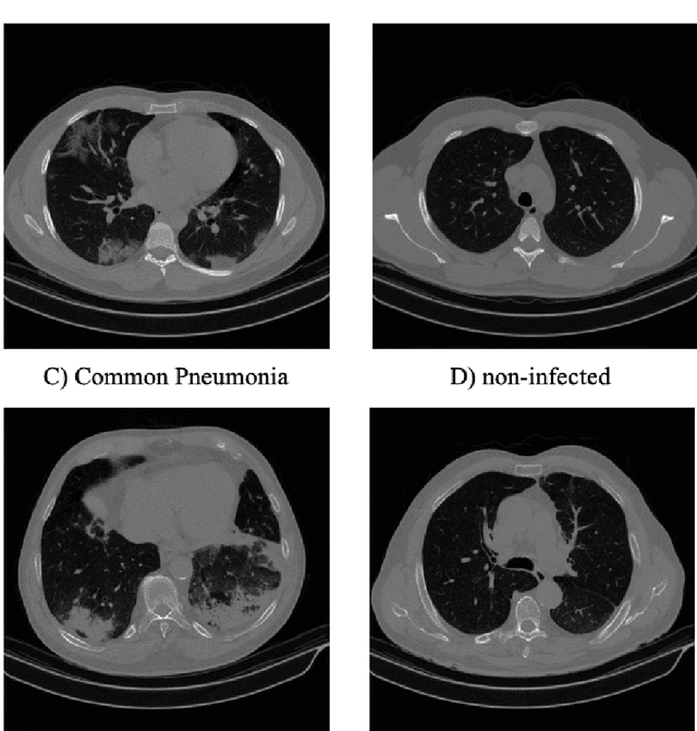 Figure 2 for COVID-FACT: A Fully-Automated Capsule Network-based Framework for Identification of COVID-19 Cases from Chest CT scans