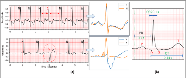 Figure 3 for Global ECG Classification by Self-Operational Neural Networks with Feature Injection