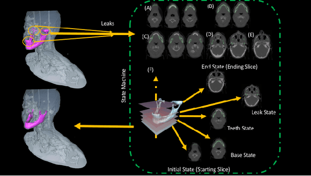 Figure 3 for Robust and fully automated segmentation of mandible from CT scans