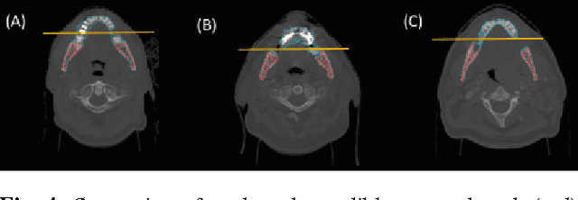 Figure 4 for Robust and fully automated segmentation of mandible from CT scans