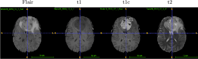 Figure 1 for Glioma Prognosis: Segmentation of the Tumor and Survival Prediction using Shape, Geometric and Clinical Information