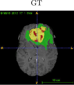 Figure 3 for Glioma Prognosis: Segmentation of the Tumor and Survival Prediction using Shape, Geometric and Clinical Information