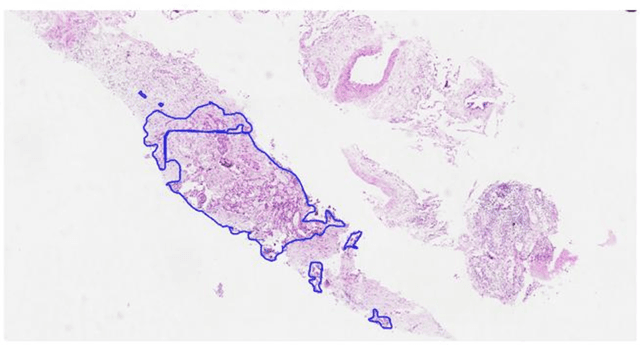 Figure 1 for Computer-aided diagnosis of lung carcinoma using deep learning - a pilot study