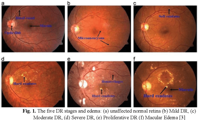 Figure 1 for DiaRet: A browser-based application for the grading of Diabetic Retinopathy with Integrated Gradients
