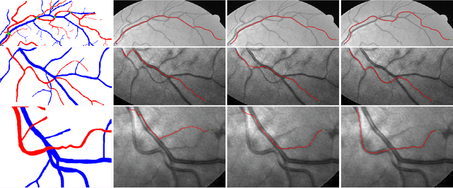 Figure 4 for A New Coherence-Penalized Minimal Path Model with Application to Retinal Vessel Centerline Delineation