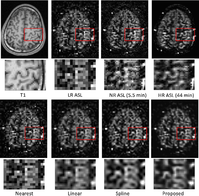 Figure 4 for Super Resolution of Arterial Spin Labeling MR Imaging Using Unsupervised Multi-Scale Generative Adversarial Network